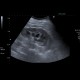 Parapelvic cysts, intrasinusoidal, central cysts: US - Ultrasound